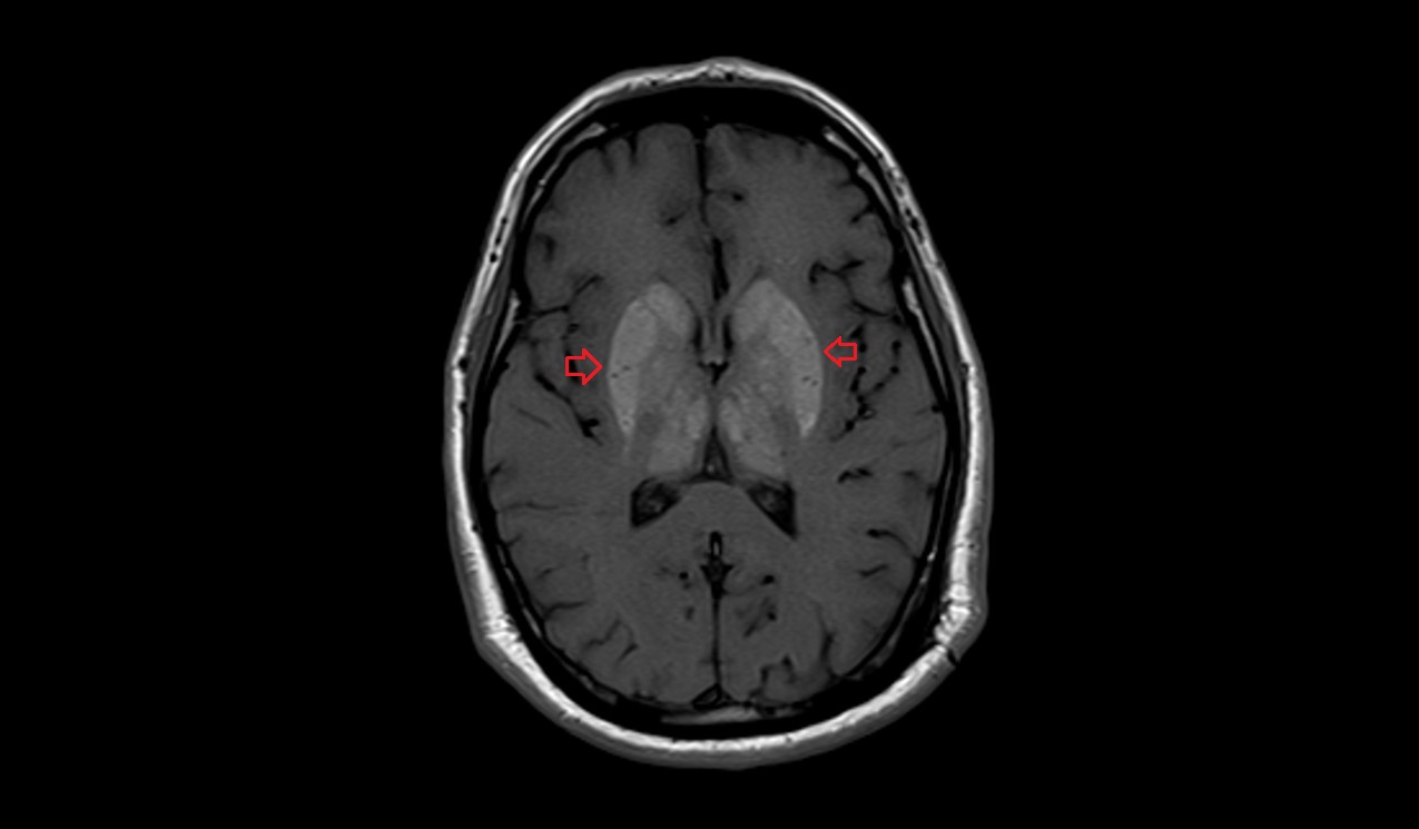 Fahr Syndrome MRI