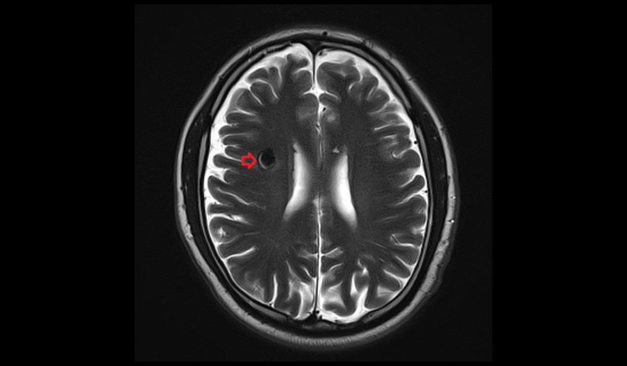 T2 axial image shows cavernoma 1