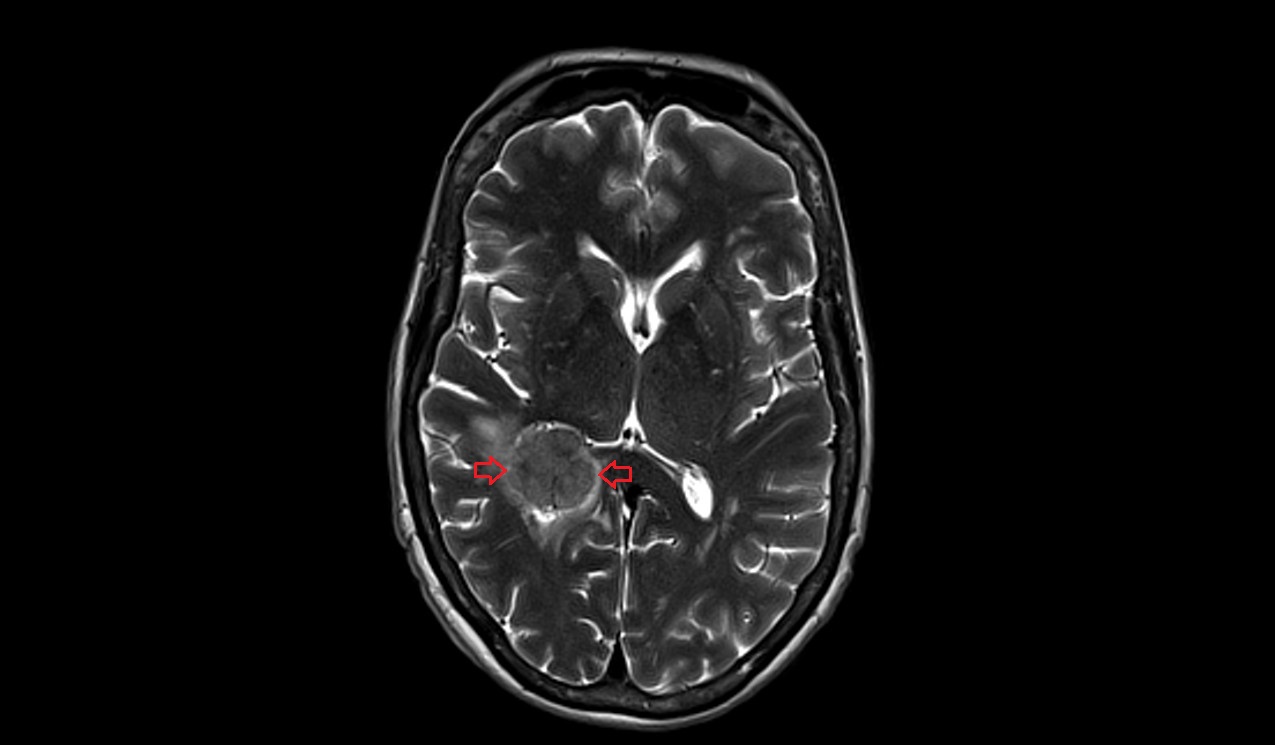 choroid plexus papilloma mri