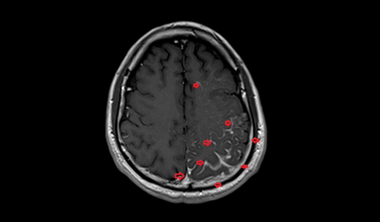 T1 axial post contrast images shows Sturge-Weber syndrome