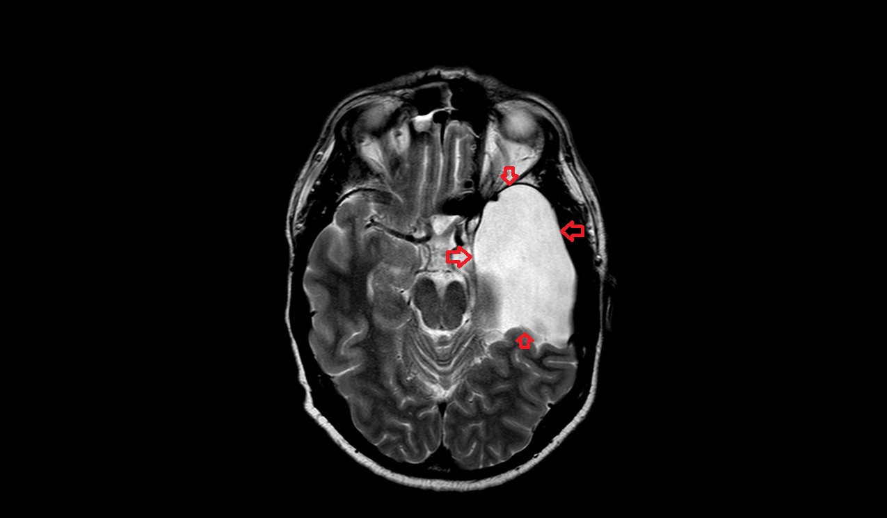 T2 axial image shows Arachnoid cyst