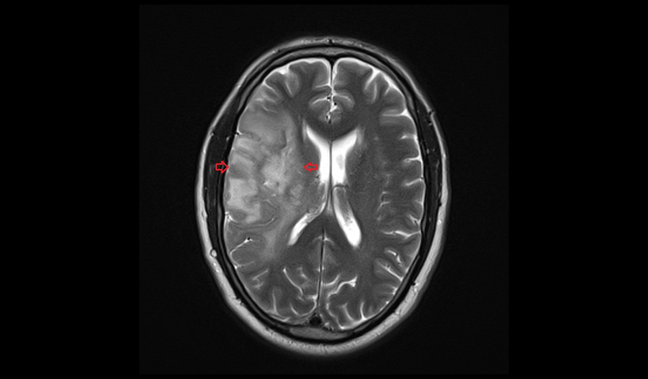 T2 axial image shows Oligodendroglioma