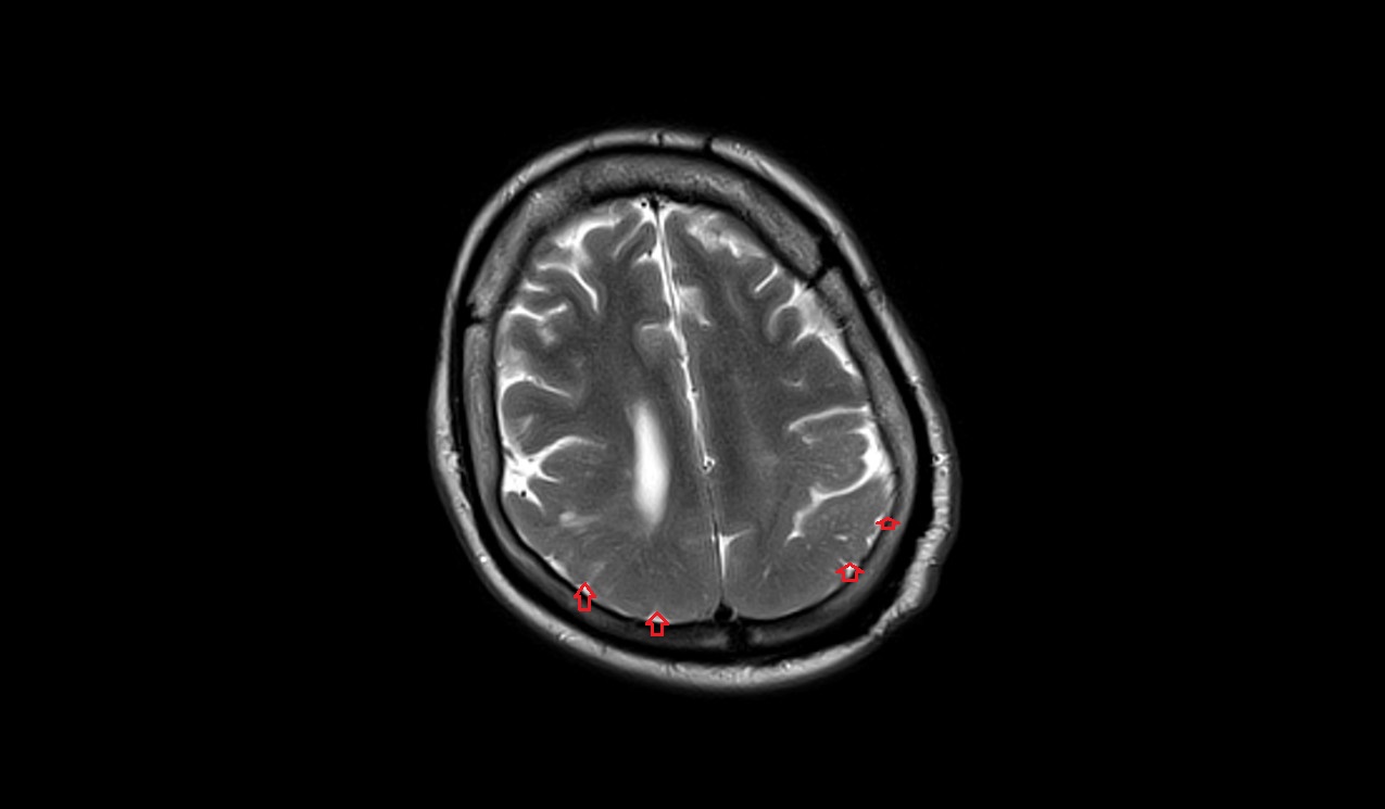 T2 axial image shows Pachygyria 1