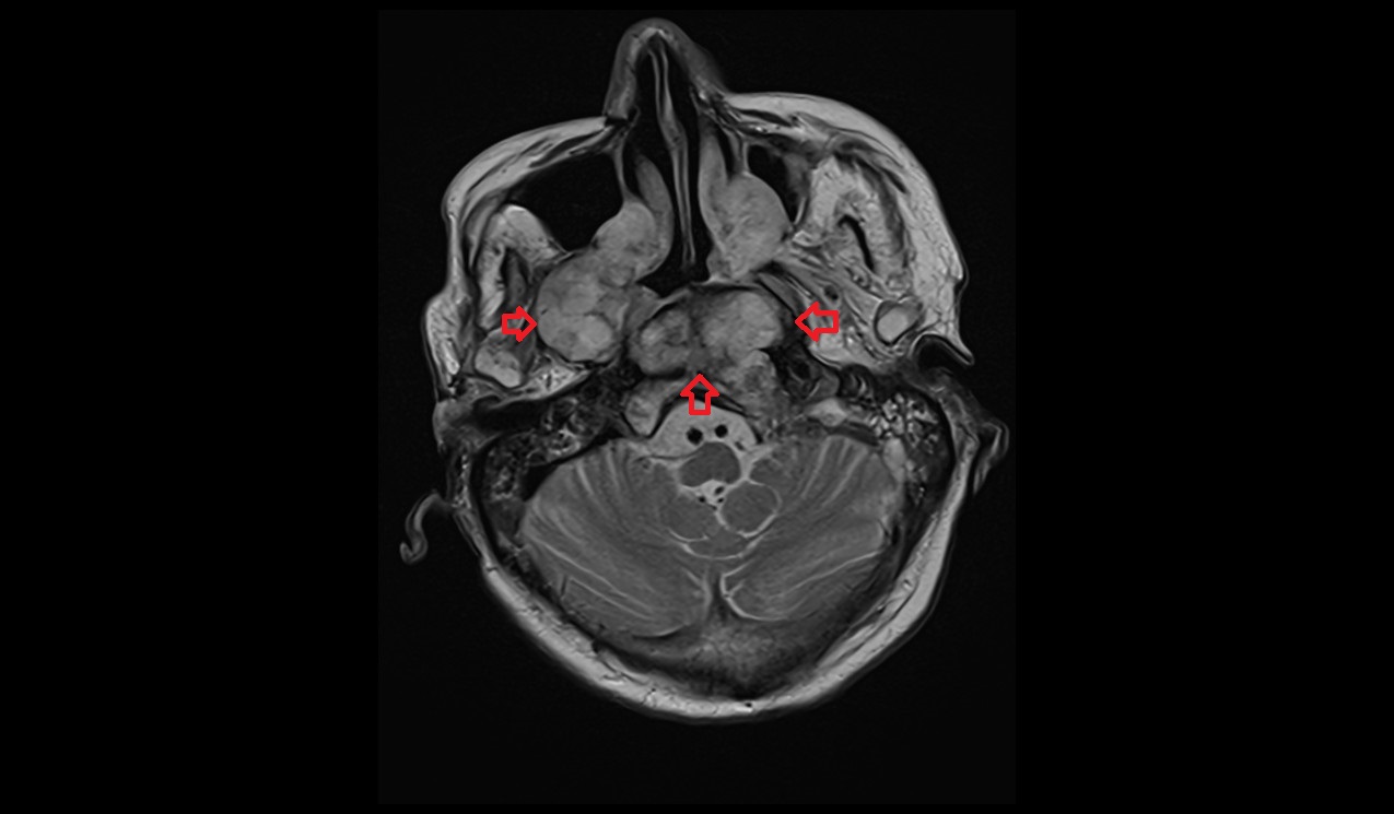 T2 axial image shows clival chordoma