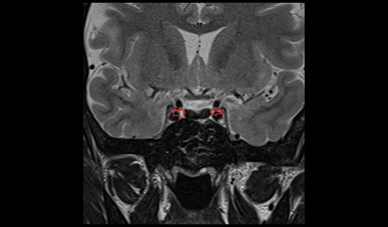 Pituitary Iron Overload