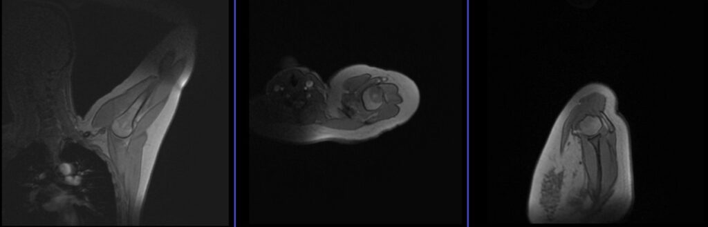 ABER (ABduction and External Rotation) MRI view localiser image