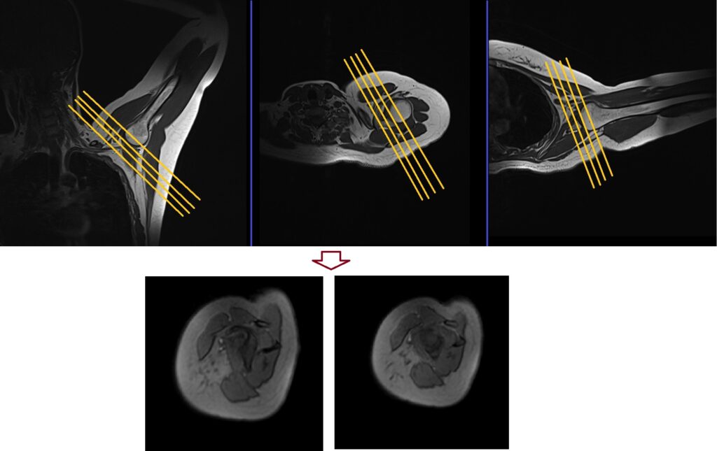 ABER (ABduction and External Rotation) MRI view sagittal localiser planning