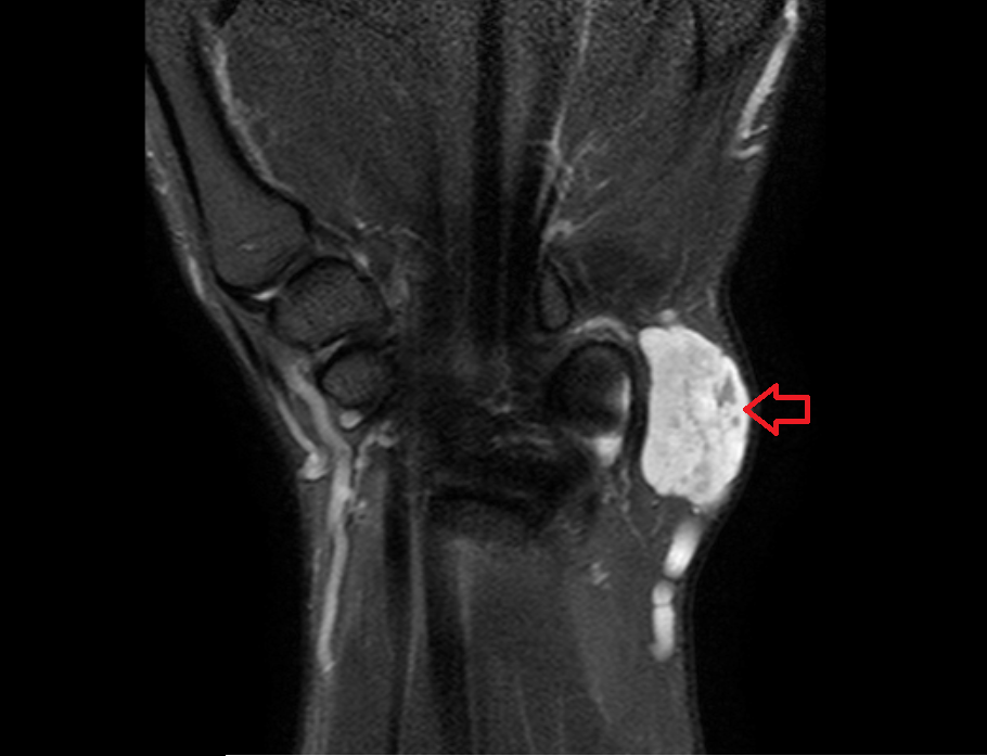 wrist hemangioma mri