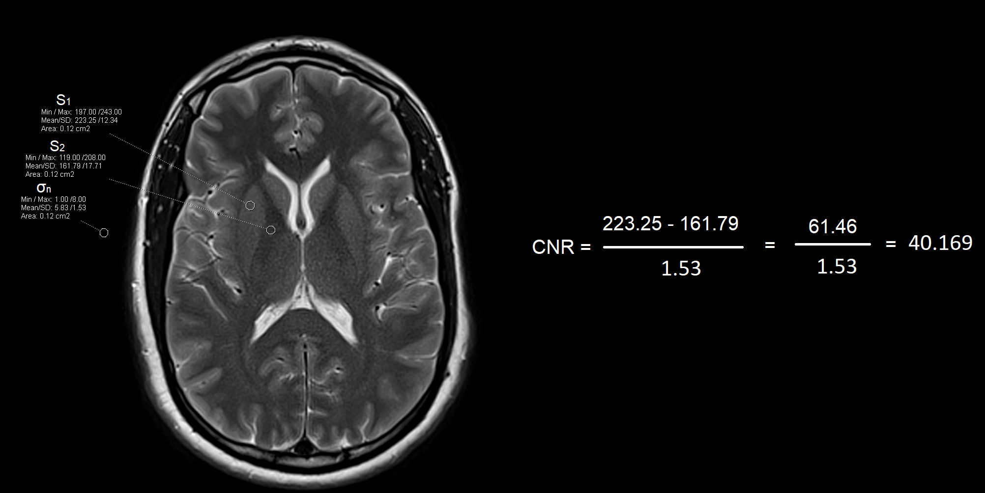 Contrast-to-Noise Ratio (CNR) and it's calculation in MRI