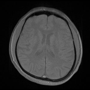 MRI Flip angle. low flip angle image MRI Flip angle. low flip angle image