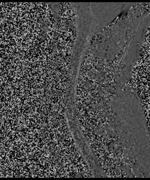CSF Flow Phase Image – Cervical Spine3 CSF Flow Phase Image - Cervical Spine3