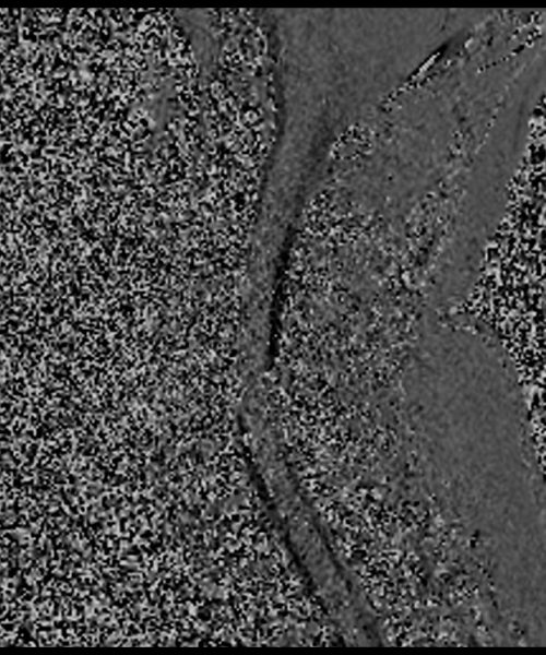 CSF Flow Phase Image – Cervical Spine5 CSF Flow Phase Image - Cervical Spine5