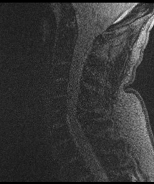 CSF Flow Re-phased Image of Cervical Spine5 CSF Flow Re-phased Image of Cervical Spine5
