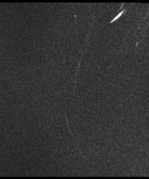 CSF Flow Magnitude Image Cervical Spine Image7 CSF Flow Magnitude Image Cervical Spine Image