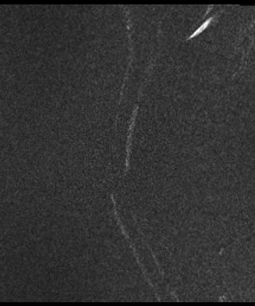 CSF Flow Magnitude Image Cervical Spine Image CSF Flow Magnitude Image Cervical Spine Image