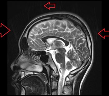 BLADE Artifact brain imaging BLADE Artifact brain imaging
