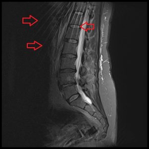 BLADE or PROPELLER Artifact spine imaging BLADE or PROPELLER Artifact spine imaging