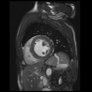 CS free breathing cine performed in an uncooperative patient. CS free breathing cine performed in an uncooperative patient.