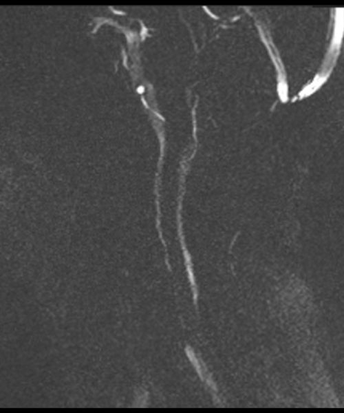 CSF Flow Chiari I Malformation Magnitude Image 2 CSF Flow Chiari I Malformation Magnitude Image 2