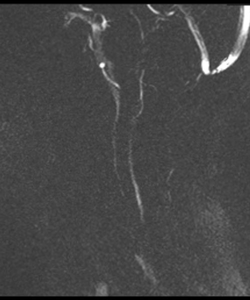 CSF Flow Chiari I Malformation Magnitude Image 3 CSF Flow Chiari I Malformation Magnitude Image 3