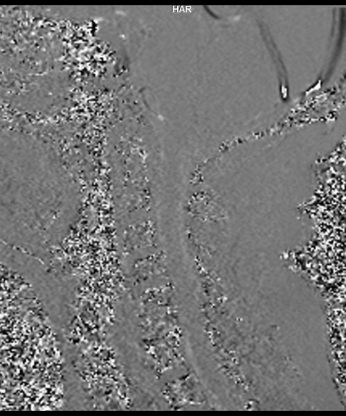 CSF Flow Chiari I Malformation Phase Image 1 CSF Flow Chiari I Malformation Phase Image 1