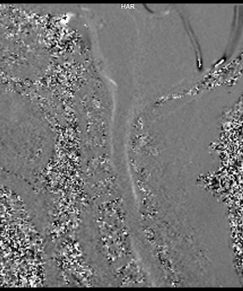 CSF Flow Chiari I Malformation Phase Image 2 CSF Flow Chiari I Malformation Phase Image 2