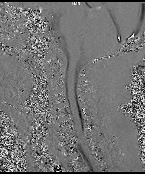 CSF Flow Chiari I Malformation Phase Image 3 CSF Flow Chiari I Malformation Phase Image 3