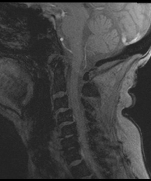 CSF Flow Chiari I Malformation Re-phased Image 2 CSF Flow Chiari I Malformation Re-phased Image 2