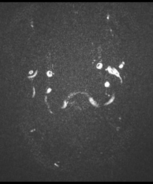 CSF Flow Chiari I Malformation through- plane Magnitude Image Image 2 CSF Flow Chiari I Malformation through- plane Magnitude Image Image 2