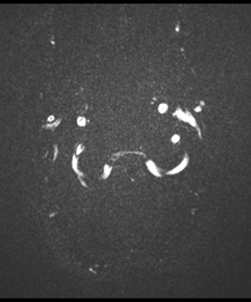 CSF Flow Chiari I Malformation through- plane Magnitude Image Image 3 CSF Flow Chiari I Malformation through- plane Magnitude Image Image 3