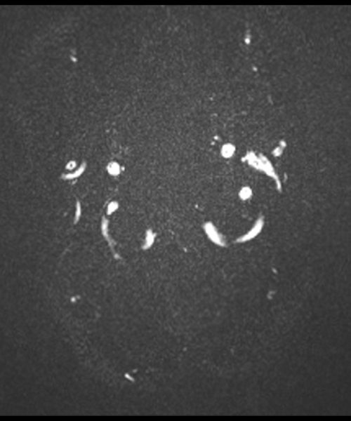 CSF Flow Chiari I Malformation through- plane Magnitude Image Image 4 CSF Flow Chiari I Malformation through- plane Magnitude Image Image 4