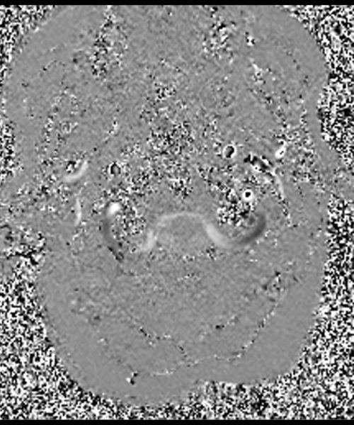 CSF Flow Chiari I Malformation through- plane Phase Image 1 CSF Flow Chiari I Malformation through- plane Phase Image 1