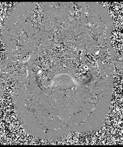 CSF Flow Chiari I Malformation through- plane Phase Image 2 CSF Flow Chiari I Malformation through- plane Phase Image 2