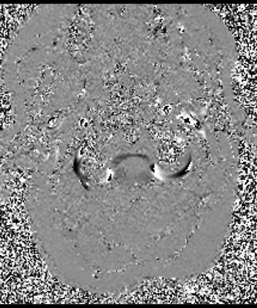 CSF Flow Chiari I Malformation through- plane Phase Image 3 CSF Flow Chiari I Malformation through- plane Phase Image 3