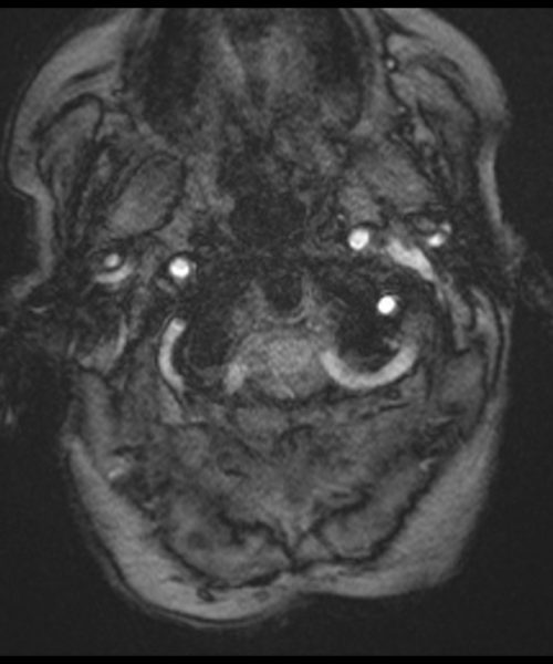 CSF Flow Chiari I Malformation through- plane Re-phased Image 3 CSF Flow Chiari I Malformation through- plane Re-phased Image 3