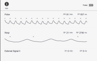 CSF flow pulse signal image CSF flow pulse signal image