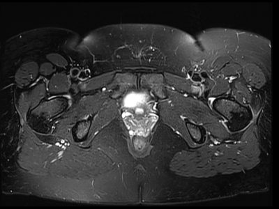 Chemical Shift Selective (CHESS) fat saturtion image pelvis Chemical Shift Selective (CHESS) fat saturtion image pelvis