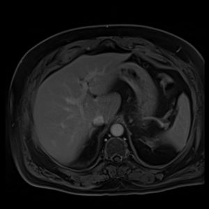 Compressed Sensing (CS) GRASP VIBE of the liver Compressed Sensing (CS) GRASP VIBE of the liver