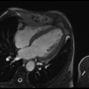 Compressed Sensing (CS) cine of the heart (2) Compressed Sensing (CS) cine of the heart (2)