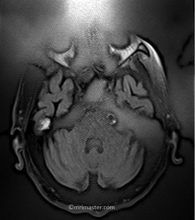 Data Clipping artifact MRI Data Clipping artifact MRI