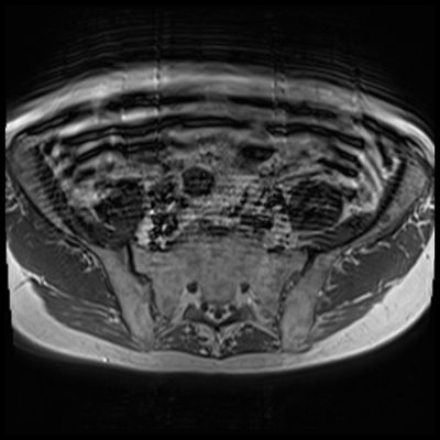 Deep Resolve Boost enhances motion artifact Deep Resolve Boost enhances motion artifact