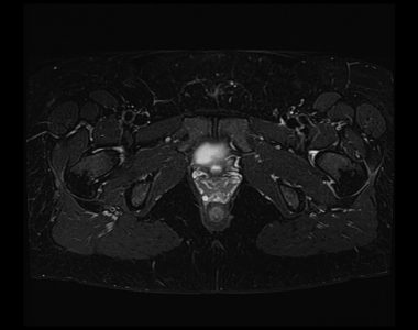 Dixon fat saturation images of pelvis 1 Dixon fat saturation images of pelvis 1