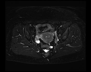 Dixon fat saturation images of pelvis Dixon fat saturation images of pelvis