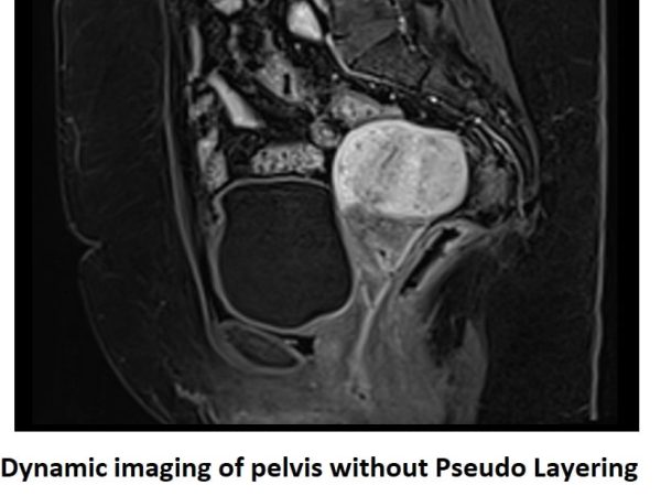 Dynamic imaging of pelvis without Pseudo Layering Dynamic imaging of pelvis without Pseudo Layering