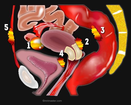 Endometriosis photo Endometriosis photo