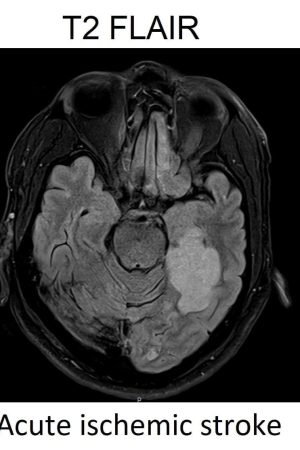 FLAIR image acute infarct FLAIR image acute infarct