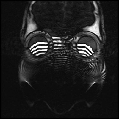 Field Inhomogeneity related Zebra Artifact Field Inhomogeneity related Zebra Artifact