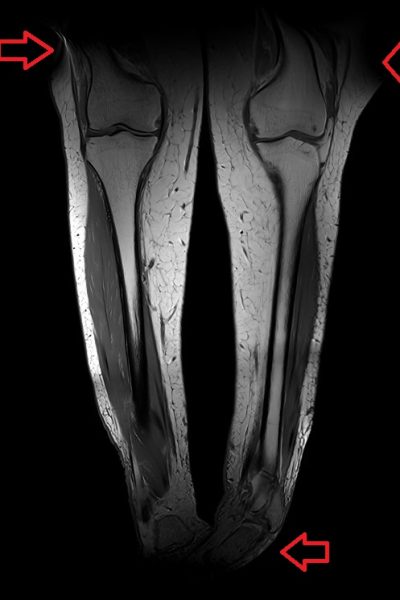 Gradient non-linearity artifact Image distortion artifact Gradient non-linearity artifact Image distortion artifact