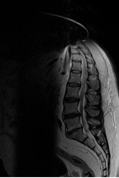 Gradient nonlinearity artifact in MRI Gradient nonlinearity artifact in MRI
