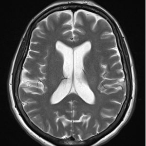 MRI Echo train length (ETL) 10 MRI Echo train length (ETL) 10